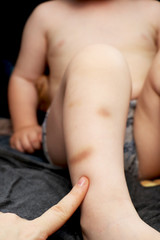Fototapeta premium Bruises on the legs of the boy