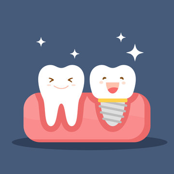 Dental implant and a normal tooth. Restoration in the oral cavity. Flat illustration on the theme of dentistry. Vector illustration isolated on blue background.