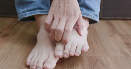 man with athlete foot
