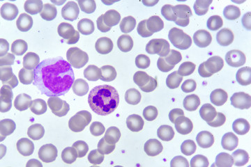 Monocyte and neutrophil cell in blood smear, analyze by microscope