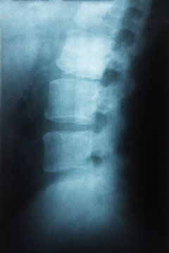 Film x-ray lumbar spine , L-S spine AP,Lateral view Grade spondylolithesis of L5-S1 , Decresed height of intervertebral disc space
