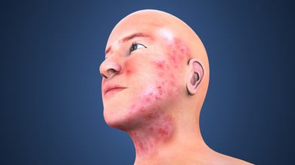 3d illustration of acne on skin face, note select focus with shallow depth of field
