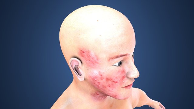 3d Illustration Of Acne On Skin Face, Note Select Focus With Shallow Depth Of Field