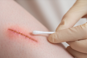 A doctor cleans a wound with an alcohol swab