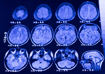 The result of MRI of the brain of a healthy person with blue backlight. The longitudinal section of...