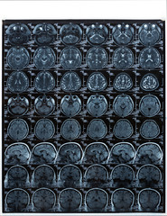 Magnetic resonance imaging (MRI) of human brain for medical diagnosis