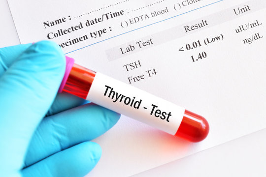 Blood sample tube with abnormal thyroid hormone test result 