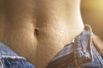 Stretch marks skin, Woman showing stretch marks on the lower abdomen.