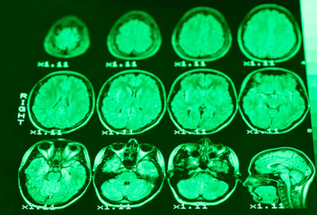 The result of MRI of the brain of a healthy person with green light. The longitudinal section of the brain. .