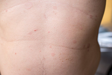 Ringworm on the body