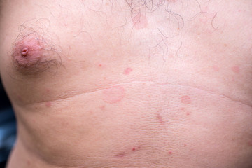 Fototapeta premium Ringworm on the body