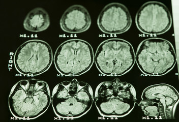 ..The result of MRI of the brain of a healthy person with a gray backlight. The longitudinal section of the brain. .