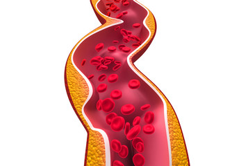 Cholesterol plaque in artery on isolated background