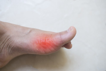 Rheumatoid Arthritis