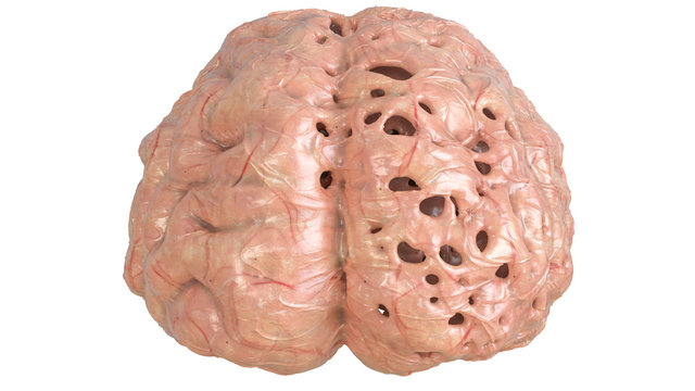 Brain in severe brain disease, Dementia, Alzheimer, Chorea Huntington - 3D Rendering