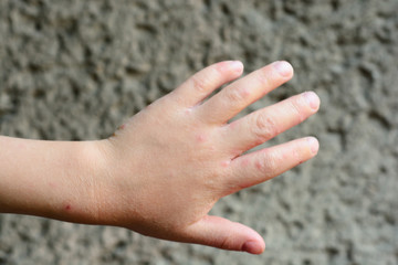 Atopic dermatitis erythematous squamous form.