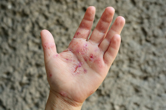 .Defeat of the skin. Pyadermia in children.