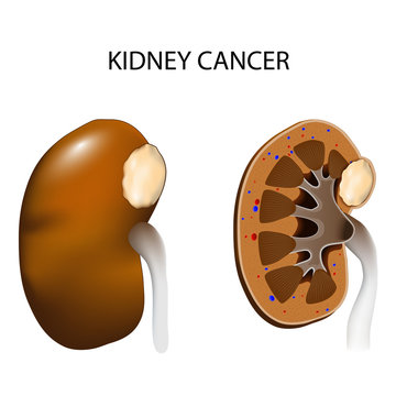 Kidney Cancer