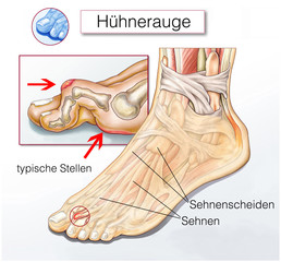 Hühnerauge © Henrie