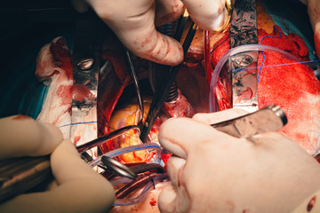 Cardiovascular surgery doctor in surgery center for interventions with instruments in surgeon operation electrosurgery with thoracotomy microsurgery doing minimal invasive open heart surgery