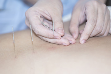The physiotherapist is doing acupuncture on the back of a female patient. Patient is lying down on...