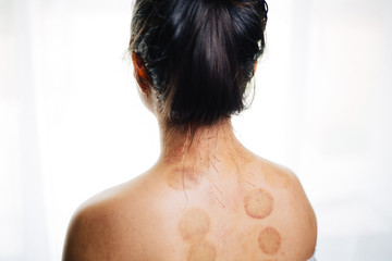 Female back featuring cupping marks and acupuncture needles on neck for pain relief