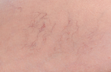 Spider veins. Varicose veins under woman skin