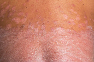 Fototapeta premium The back is full of psoriasis