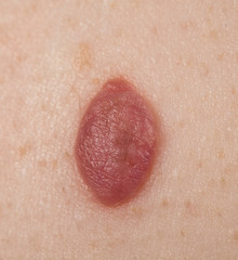 Fototapeta premium Inborn mole close up. Macro shot of benign skin lesion. Proliferation of pigment derma cells, melanocytic pigmented naevus, naevocytic nevus.