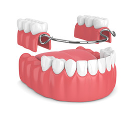 3d render of removable partial denture