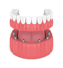 3d render of removable full implant denture