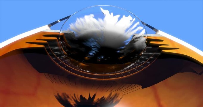 Posterior capsule opacification after cataract surgery, YAG laser capsulotomy, cg animation on blue background, 3d render, 4K