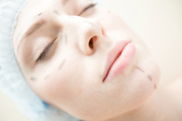 Fototapeta na wymiar Face of young woman with marks on face ready for lifting procedure