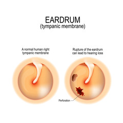 Ruptured (perforated) eardrum - obrazy, fototapety, plakaty