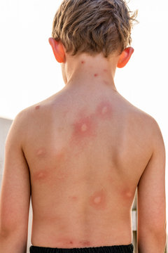 Boy child with many infected mosquito bites on his back. Skin with redness and allergic reaction.