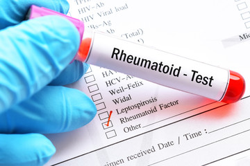 Blood sample with laboratory requisition form for rheumatoid factor (RF) test