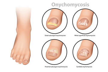 Fungal Nail Infection. Onychomycosis or tinea unguium. Four classic types of onychomycosis - obrazy, fototapety, plakaty