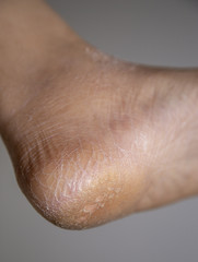 Dry skin cracked on heel