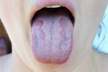 Oral Candidiasis or  Oral trush ( Candida albicans), yeast infection on the human tongue close up,...