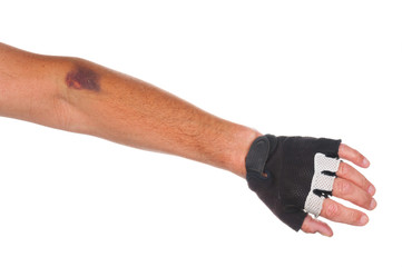 Bruise on cyclist arm on white background