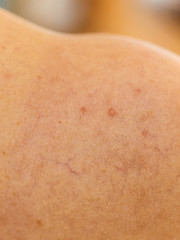 Fototapeta premium Ski with dilated capillaries ad red spots