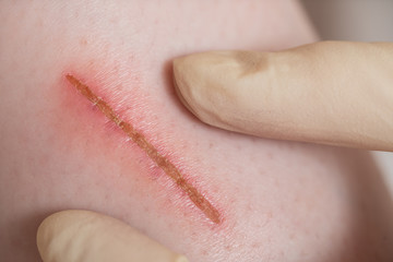 first aid for a girl