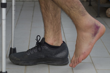 Ankle sprain after a volleyball match