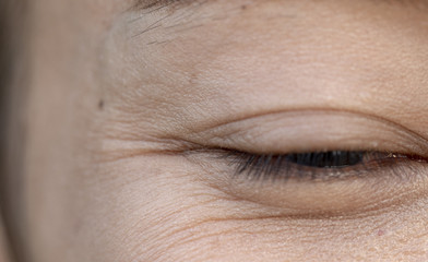 Wrinkles around the eyes