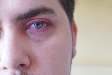 Close up left upper eyelid abscess. Eye pain
