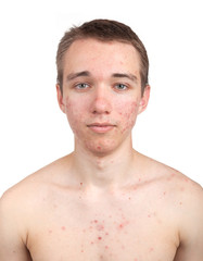 Handsome young man with skin problem