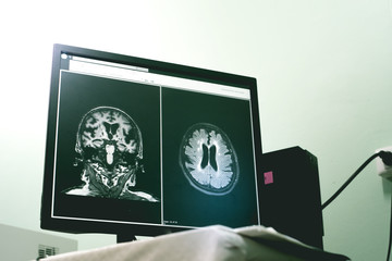 small vessel disease and dementia on film MRI 