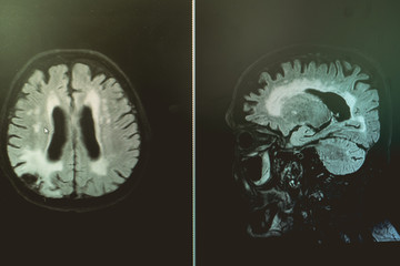 AD with CVD  white matter change