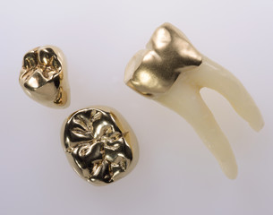 Goldkronen Gusskrone auf dem Zahn