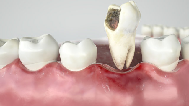 Caries in three stages - Stage 3 tooth extraction - 3D Rendering